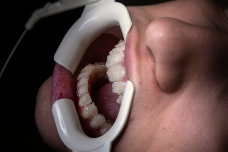 Eugenol vs Non-Eugenol Temporary Cement