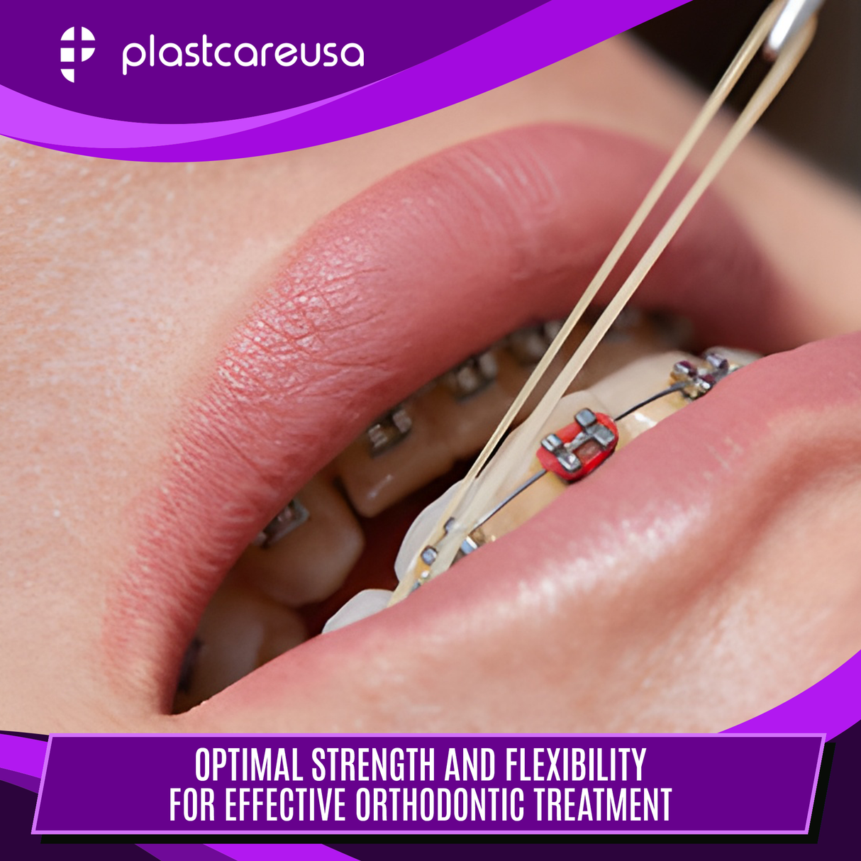 2000 (1/4" Fox, Heavy 6.5 Oz) Assorted Colors Orthodontic Latex Elastic Rubber Bands for Braces