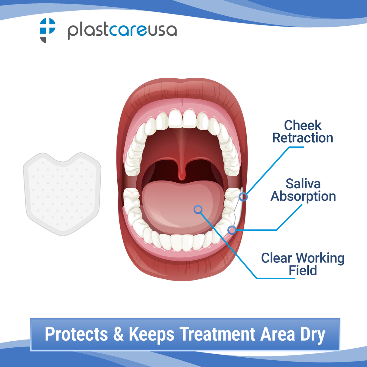 200 Large Dental Angle Saliva Absorbent Dry Corners, Mouth Cotton Roll Substitute w/ Backing