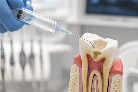 Endodontic irrigation syringe delivering irrigant during root canal treatment
