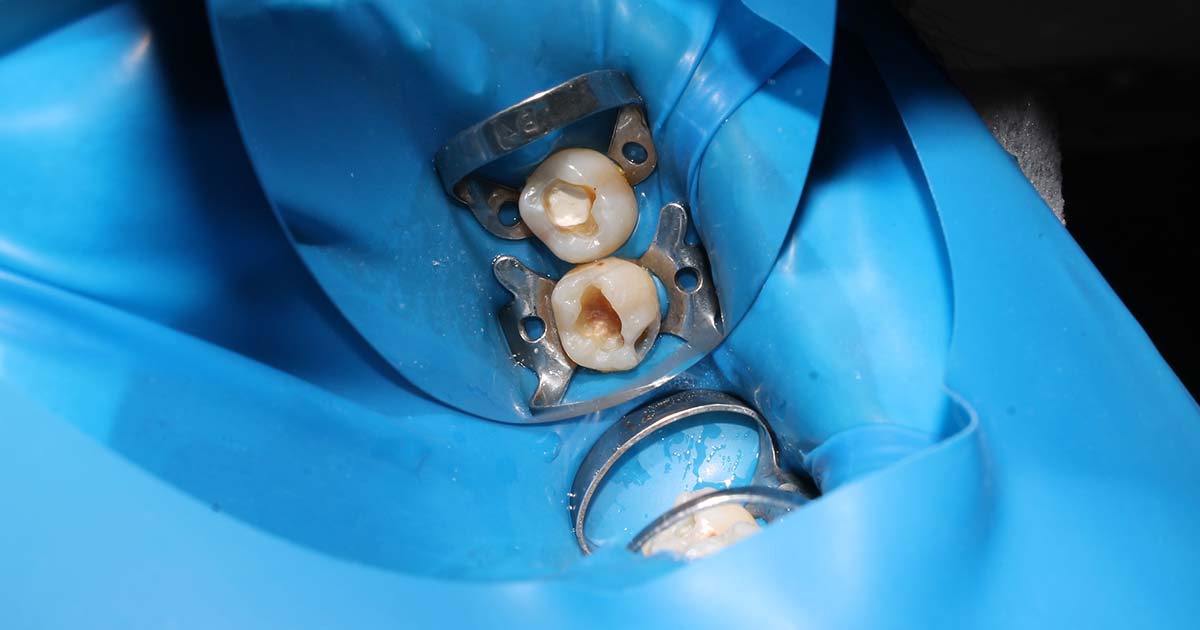 The Essential Guide to Dental Rubber Dams and Sizing: Why Quality and Fit Matter