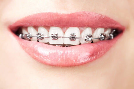 The Benefits of Orthodontic Patient Care Kits (Pre‑Assembled Braces Care Packs)